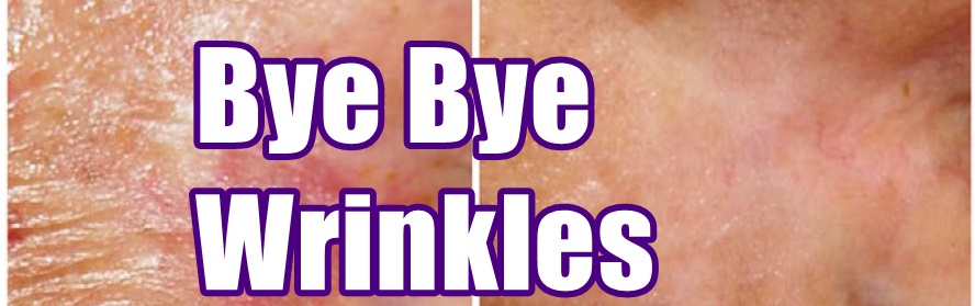 009_bye_wrinkles_Crow's feet.jpg